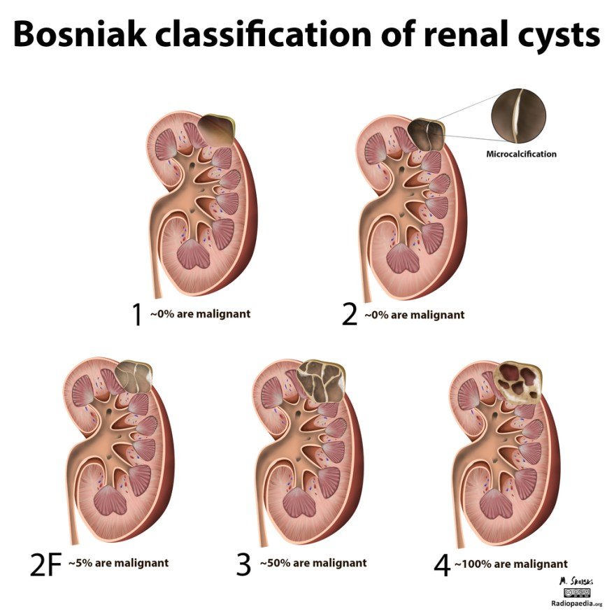 Renal cyst: simple or complex?  NephroPOCUS