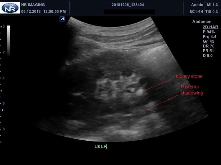 Renal Stone  Collection of Ultrasound Images
