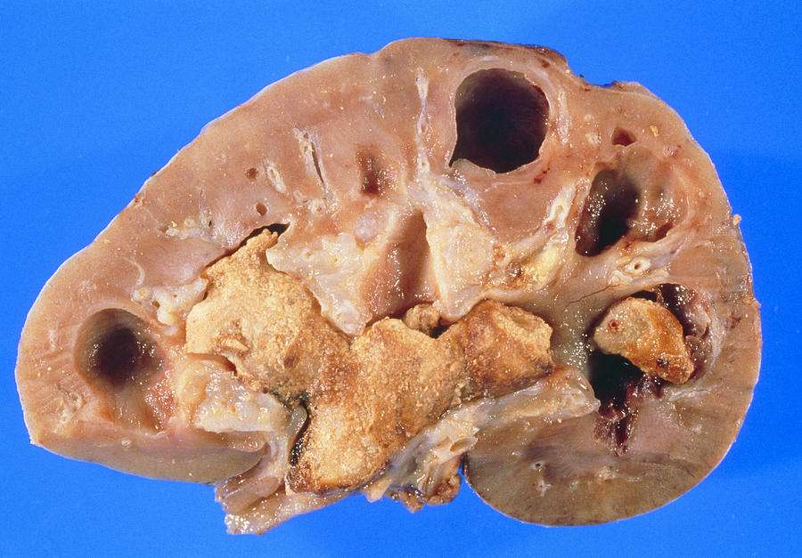 Sectioned Kidney Showing Large Staghorn S Photograph by Dr. E. Walker