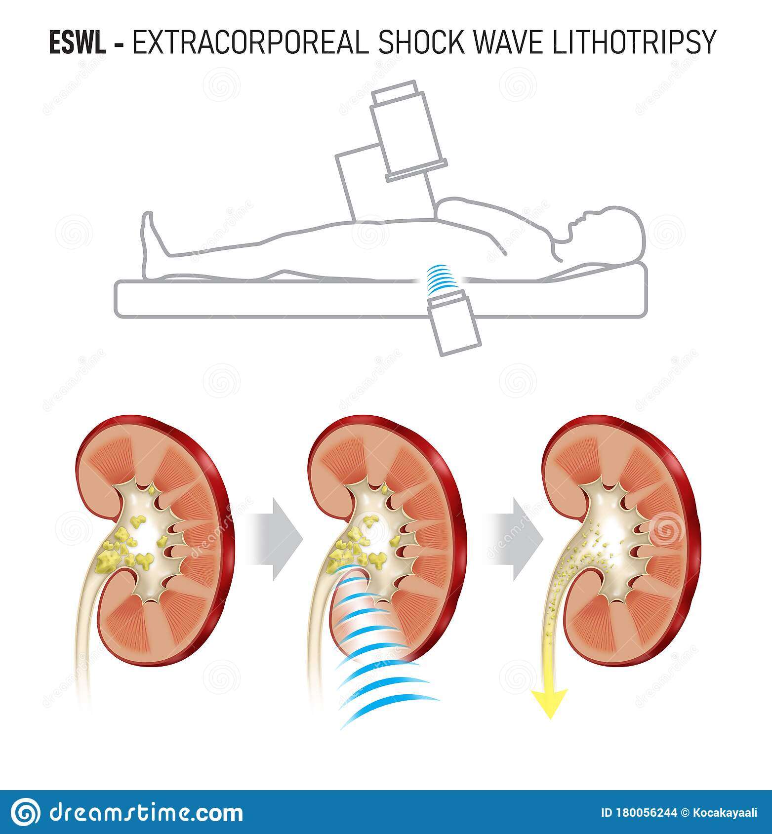 Shock Waves To Break A Kidney Stone Stock Illustration ...