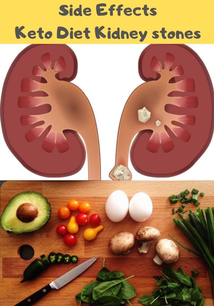 Side Effects Keto Diet Kidney stones