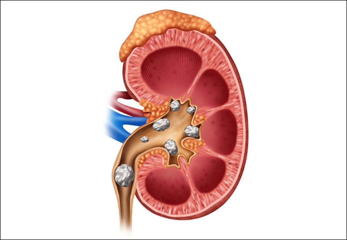 Signs And Symptoms Of Kidney Stones And Kidney Stone Pain ...