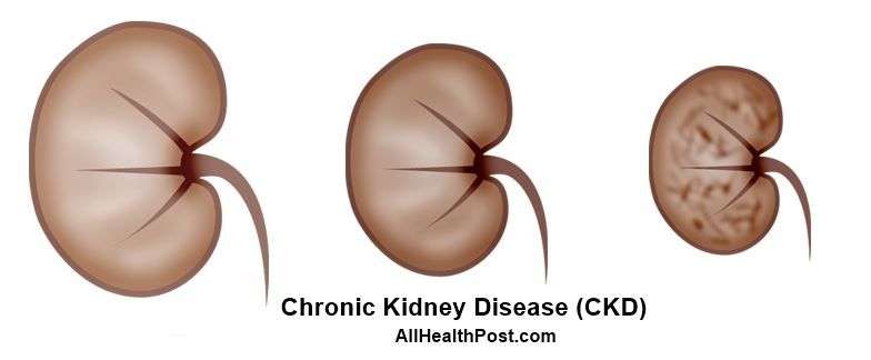 Stage 3 Chronic Kidney Disease Causes, Care and Reversal ...
