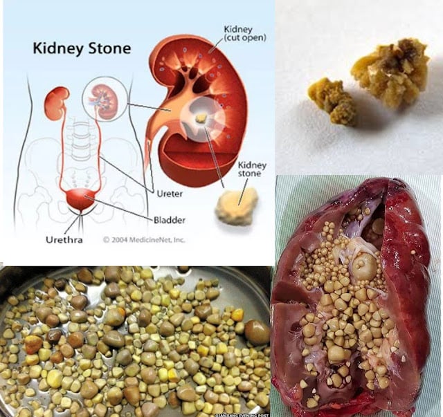 Strong and Beyond: How to Flush Kidney Stones Naturally ...