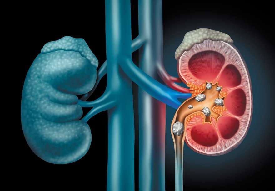 Study aims to boost water intake to prevent kidney stones