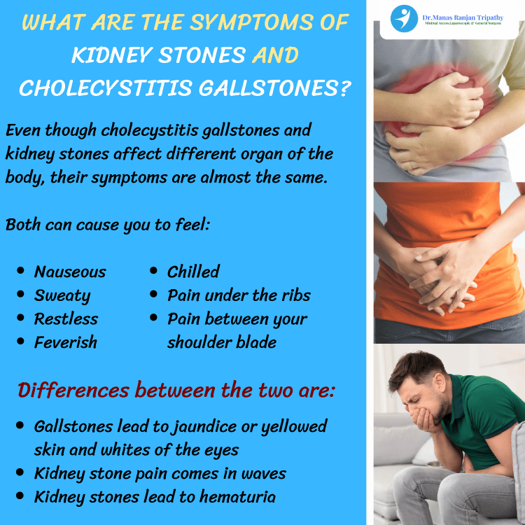 Symptoms of Kidney Stones And Cholecystitis Gallstones