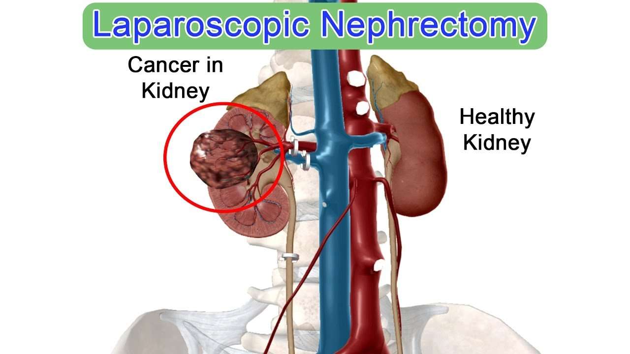 Technique of Laparoscopic Nephrectomy for Kidney Cancer ...
