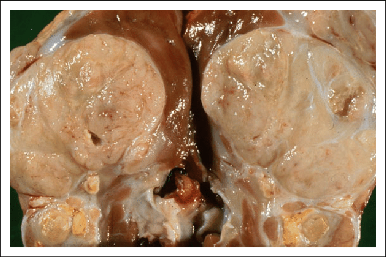 The bisected kidney demonstrates a large, tan