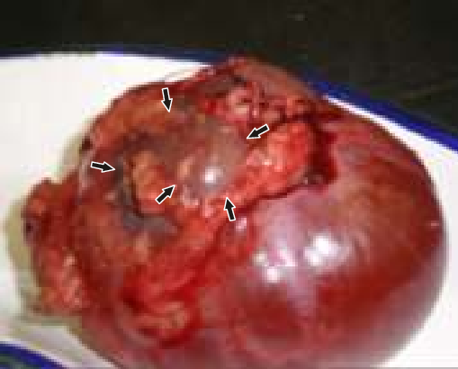 The renal cyst after its removal. The kidney (arrows) is ...