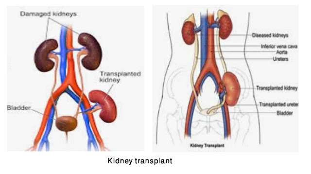 Treatment for kidney disease.