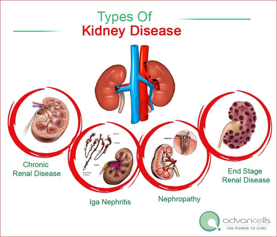 Types Of Kidney Disease. Chronic Renal Disease, Iga Nephritis ...