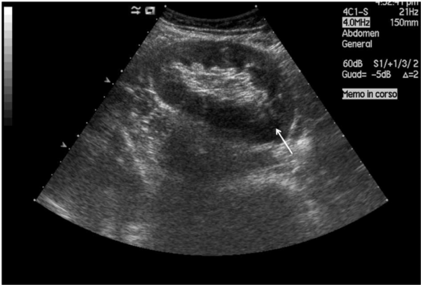 Ultrasound imaging findings of a transplanted kidney in a 30
