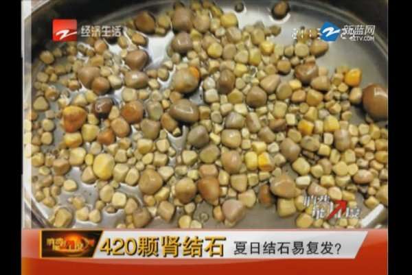 Watch: 420 stones removed from a single kidney