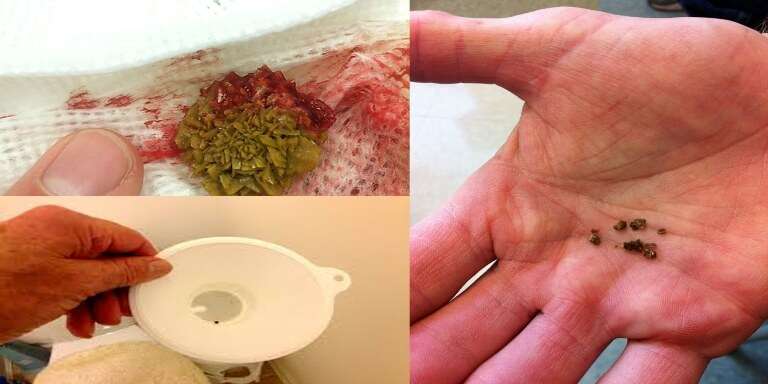 Watch Your Kidney Stones Coming Out With This Amazing Home Remedy ...
