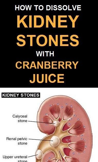 What Age Does Kidney Stones Occur