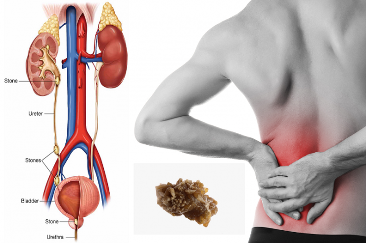What are kidney stone? and what are its symptoms? DoLatest