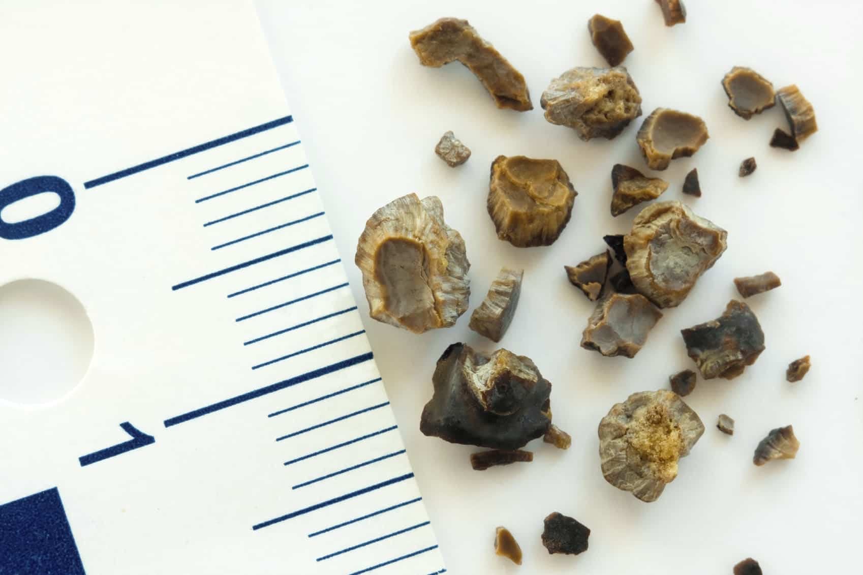 What are the causes and types of Kidney Stone