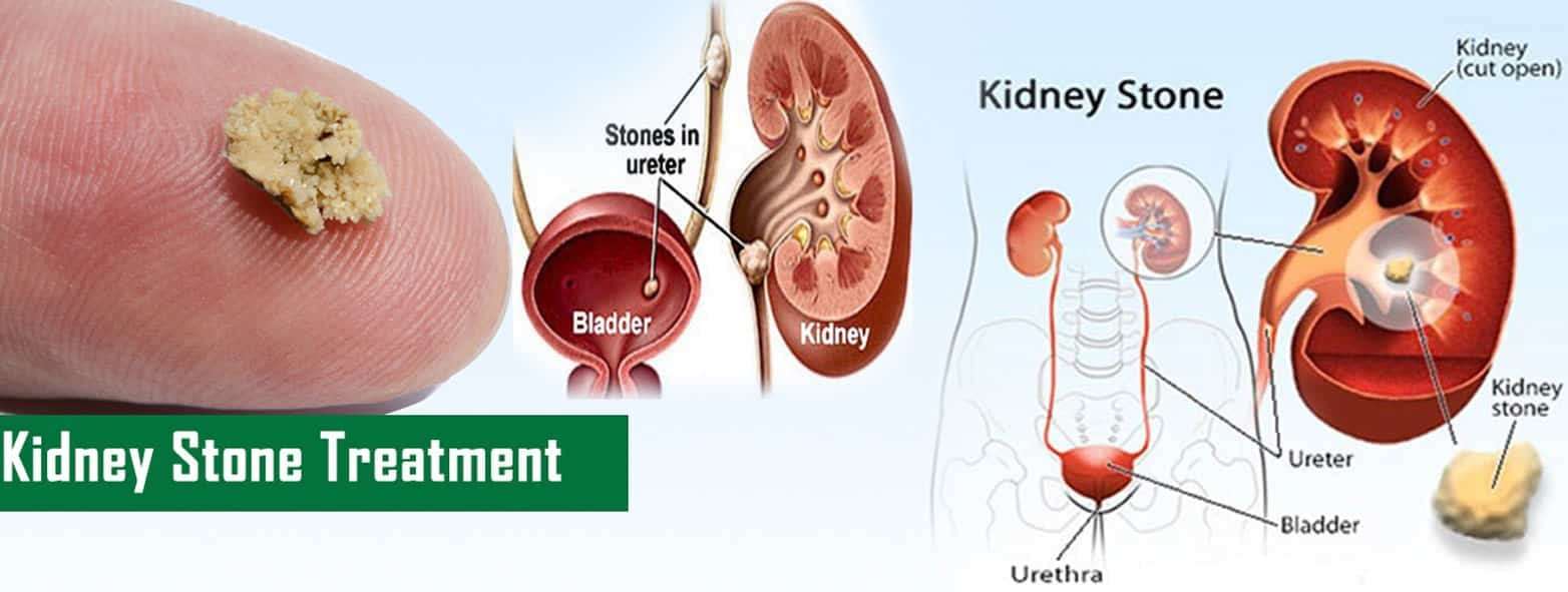 What are the causes and types of Kidney Stone