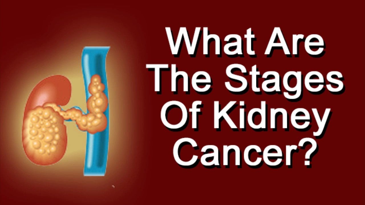 What Are The Stages Of Kidney Cancer?
