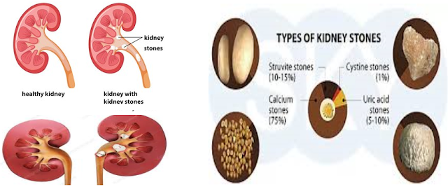 What causes of kidney stones?