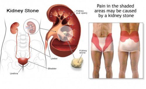 What Do Kidney Stones Feel Like Female
