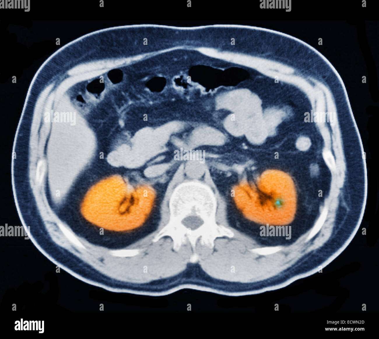 What Do Kidney Stones Look Like On A Ct Scan