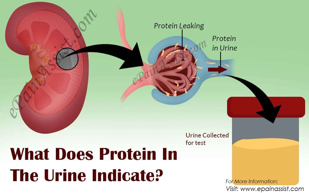 What Does Protein In The Urine Indicate?