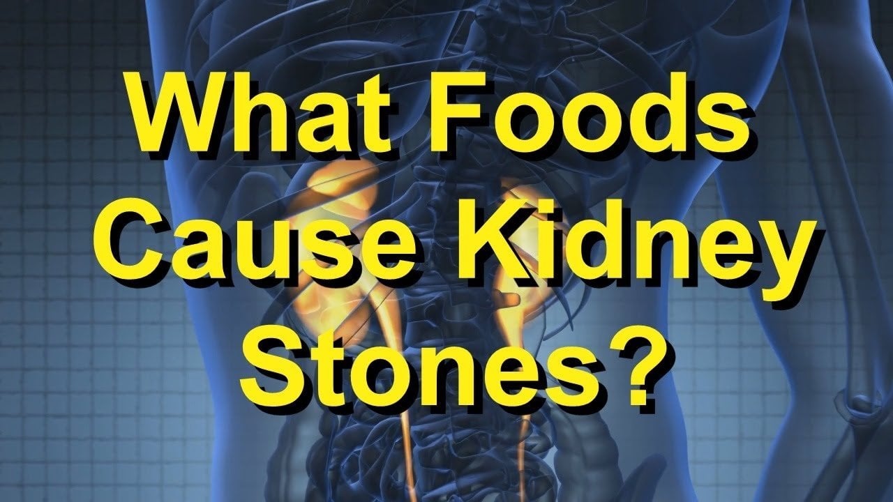 What Foods Cause Kidney Stones?
