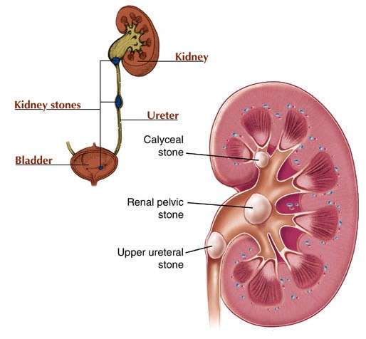 What Happens When A Kidney Stone Is Stuck In The Urethra