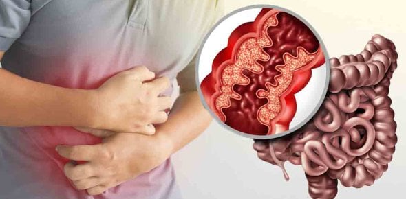 What is crohn disease?