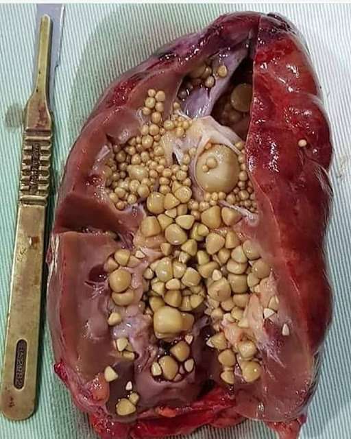 What Is Gallstones?