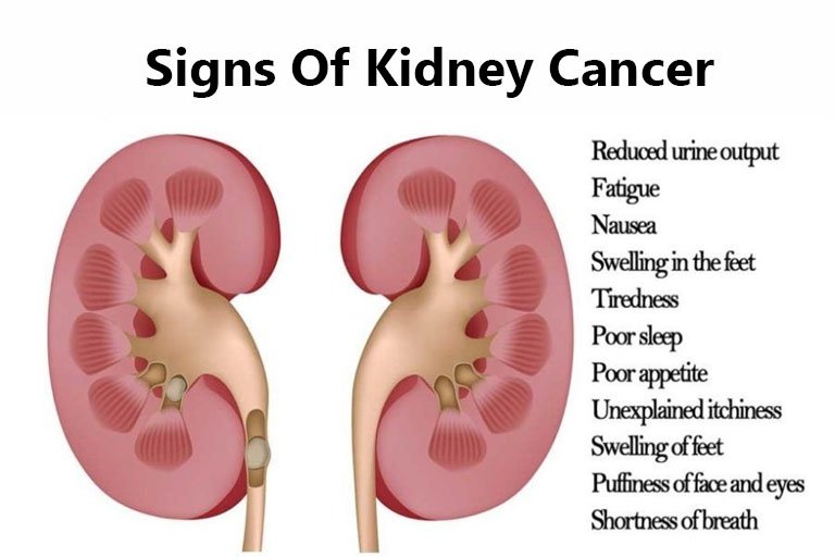 What Is Kidney Cancer ? How To Prevent Kidney Problems ...