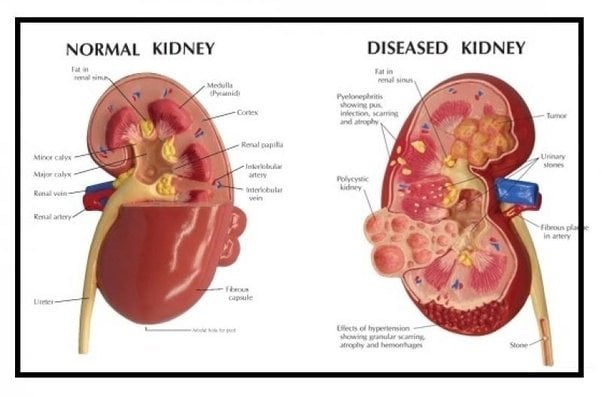 What is kidney (renal) failure?