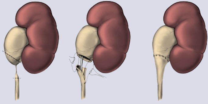 What is Ureteropelvic Junction Obstruction?