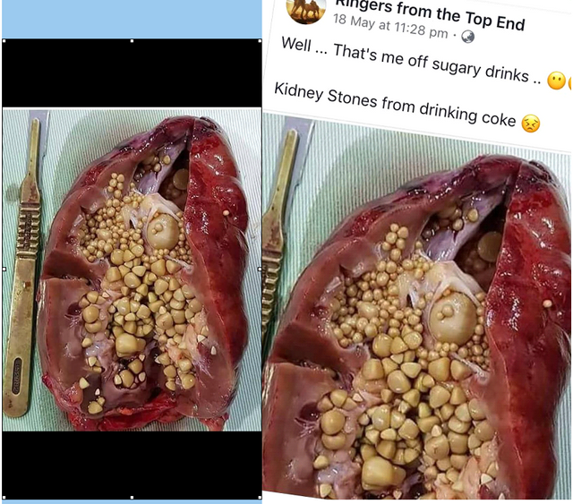 what kind of drinks cause kidney stones