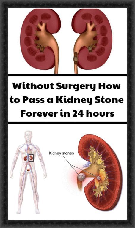 What Side Are Kidney Stones On