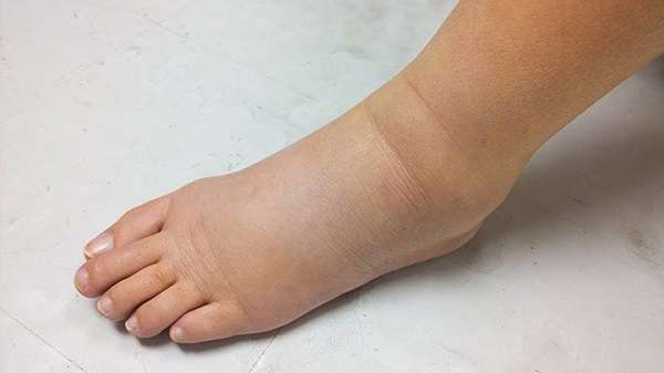 What to Do If You Have Edema