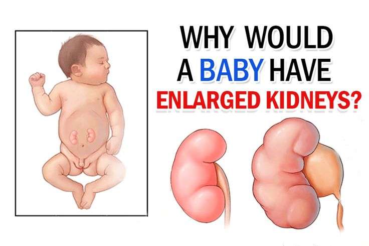 Why Would A Baby Have Enlarged Kidneys?