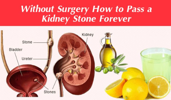 Without Surgery How to Pass a Kidney Stone Forever in 24 ...