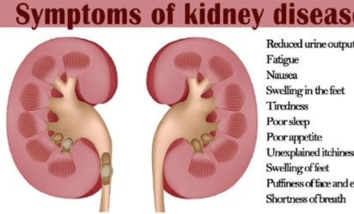 World Kidney Day: Nigerian Govt Needs To Do More For ...