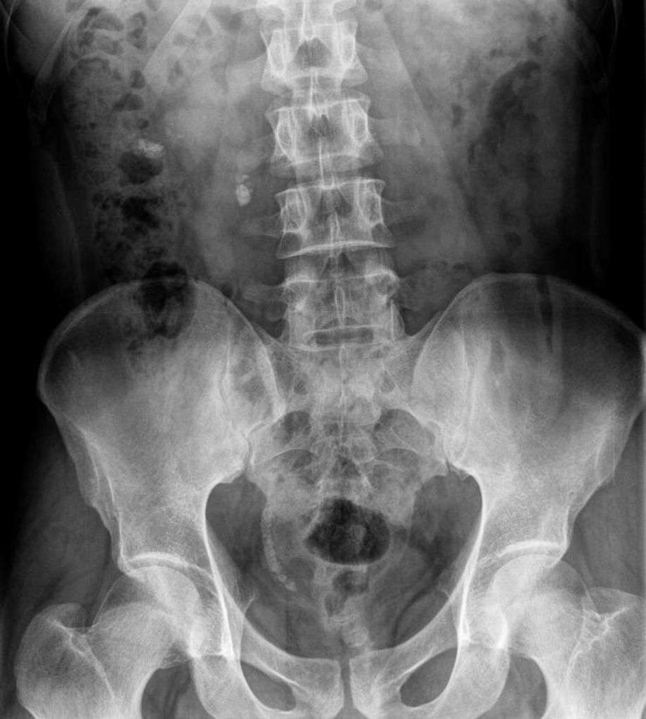 X Ray Kub Of Kidney Stones